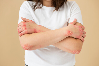 Impetigo Stop Smoking