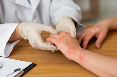 Infection Fungal Infection